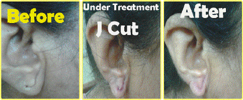 Ear Lobe J Cut.gif (152280 bytes)