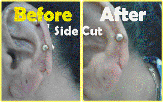 Ear Lobe Side Cut.gif (96505 bytes)