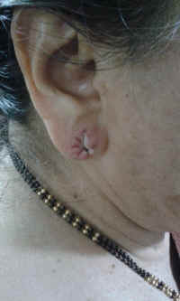 ear lobe repair 12.JPG (467849 bytes)