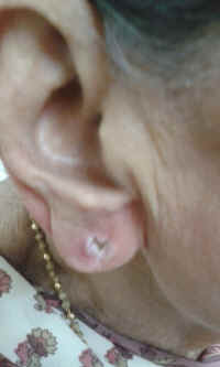 ear lobe repair 13.JPG (423495 bytes)