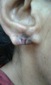 ear lobe repair 14.JPG (403641 bytes)