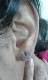 ear lobe repair 15.JPG (426144 bytes)