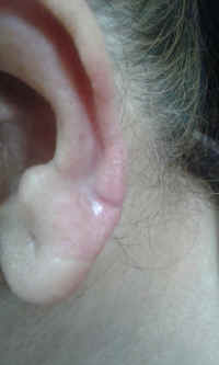 ear lobe repair 16.1.jpg (225509 bytes)