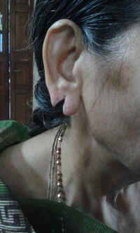 ear lobe repair 19.jpg (537963 bytes)