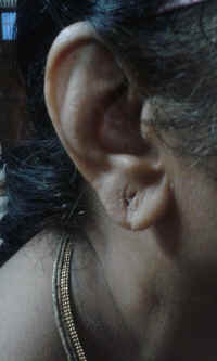 ear lobe repair 20.jpg (479491 bytes)