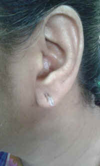 ear lobe repair 21.jpg (452436 bytes)