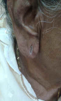 ear lobe repair 23.jpg (530429 bytes)