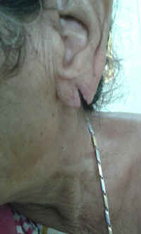 ear lobe repair 26.jpg (465311 bytes)